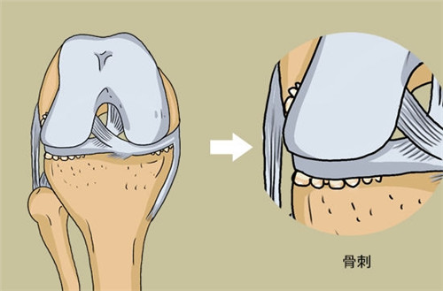 骨刺动画图