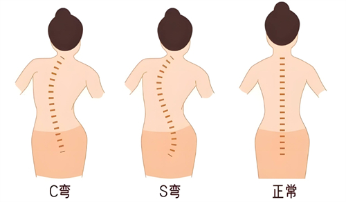 不同类型的脊柱侧弯