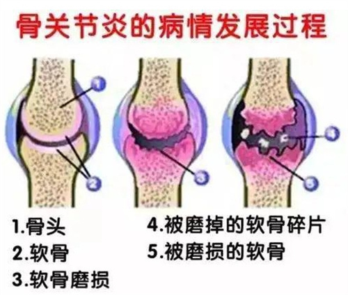 干细胞治疗膝关节炎贵吗？日本技术成熟,轻度治疗5万元起,复杂治疗10万元起！