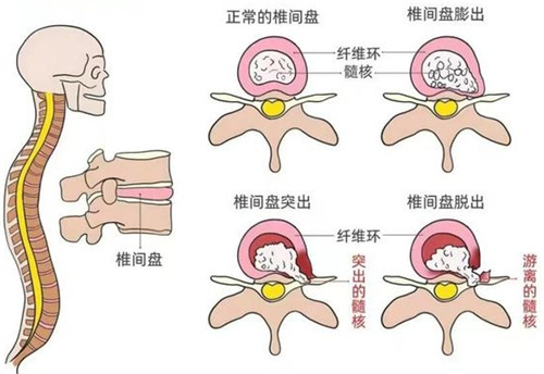 日本iPS细胞修复腰椎间盘：技术原理+修复过程+综合成效全方面解读！