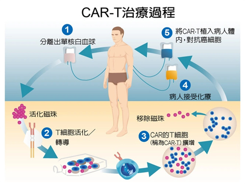 CART细胞疗法治疗过程