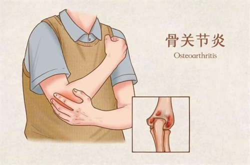 干细胞治疗骨关节炎是真的吗？真实案例呈现，半月板修复、软骨增厚见证治疗成效