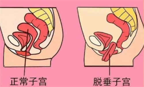 子宫脱垂对比展示