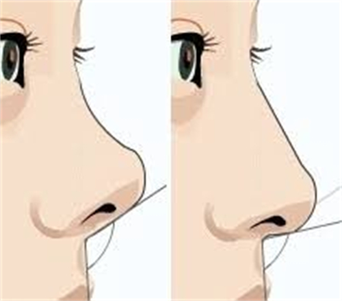 隆鼻手术膨体隆鼻前后对比