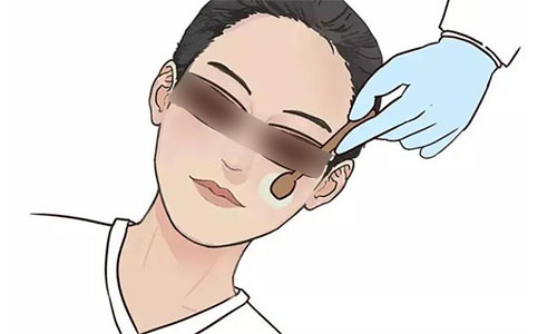 光子嫩肤示意图