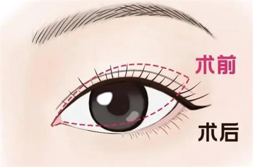 双眼皮修复手术对比