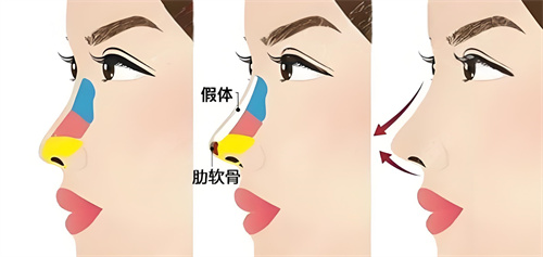 日本银座美雪通美容外科正规吗?擅长隆鼻手术,可线上预约面诊!