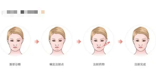 骸肌放松注射过程示意图