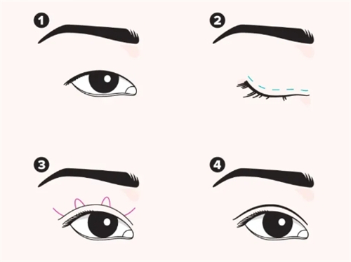 日本B-LINE美容整形外科诊所池袋院技术咋样？曝光施术细节，对比收费是否合理可信！