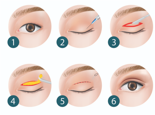 双眼皮步骤 双眼皮步骤