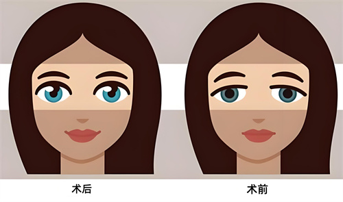 双眼皮术后术前对比动画图 双眼皮术后术前对比动画图