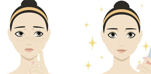 激光祛斑对比示图 激光祛斑对比示图