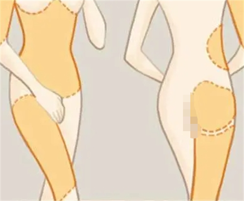 吸脂手术可以手术的部位动画展示图