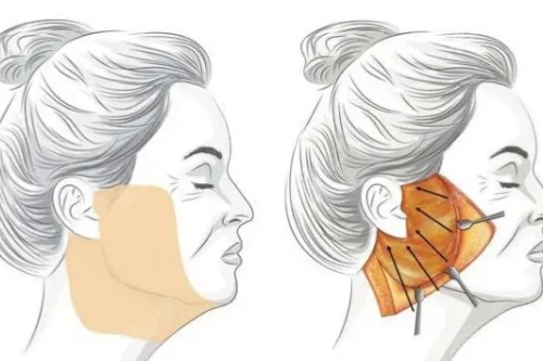 东京贝尔美容外科怎么样？做整形有一手，抗衰技术绝体验感拉满了~