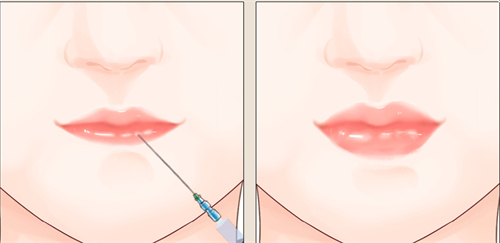 注射丰唇手术 注射丰唇手术