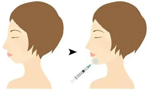 注射垫下巴前后的区别 注射垫下巴前后的区别