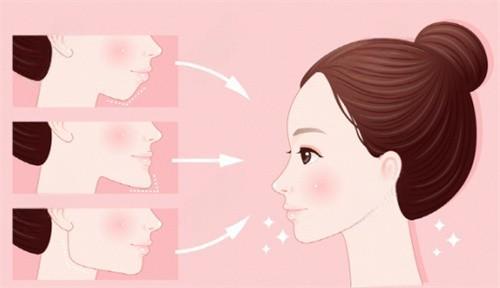 面部轮廓整形 面部轮廓整形