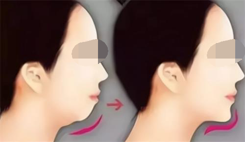 玻尿酸丰下巴后的成效 玻尿酸丰下巴后的成效