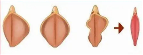 日本私密整形实例手术照片分享:小阴唇整形+阴道紧缩后变化真的很大!