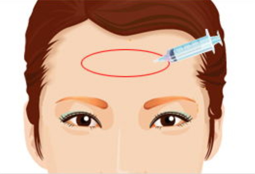 乔雅登3100元就能打？东京玻尿酸价格大揭秘，比国内省一半