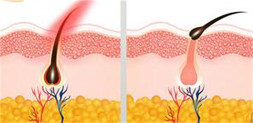 脱毛前后的变化 脱毛前后的变化