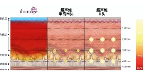 超声炮治疗深度对比 超声炮治疗深度对比