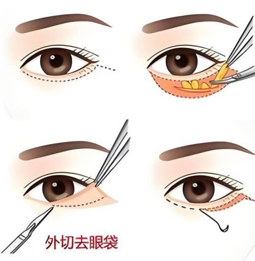 外切去眼袋演示动画图 外切去眼袋演示动画图