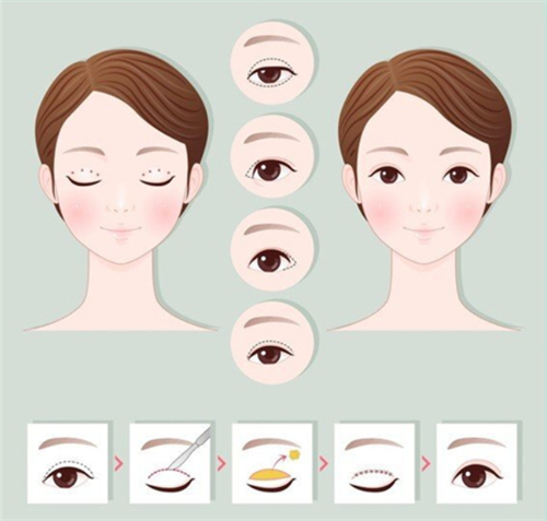 切开双眼皮手术前后对比和过程 切开双眼皮手术前后对比和过程