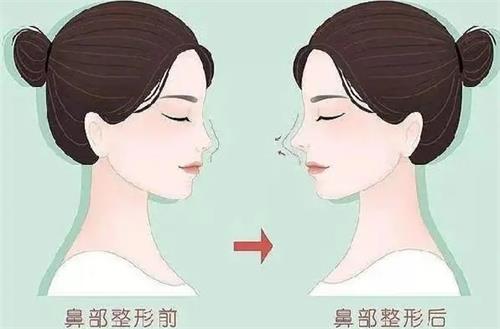 液态隆鼻前后的区别 液态隆鼻前后的区别
