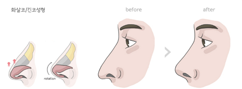 日本神成美容外科隆鼻怎么样？专注鼻整形，自然风格为主，口碑在业界不错