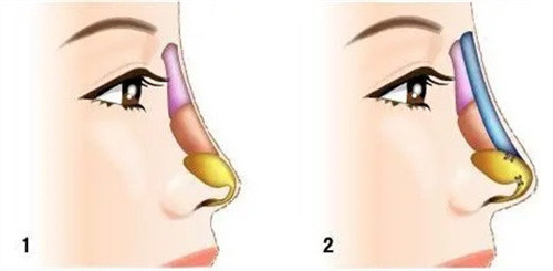 不同材料隆鼻对比 不同材料隆鼻对比