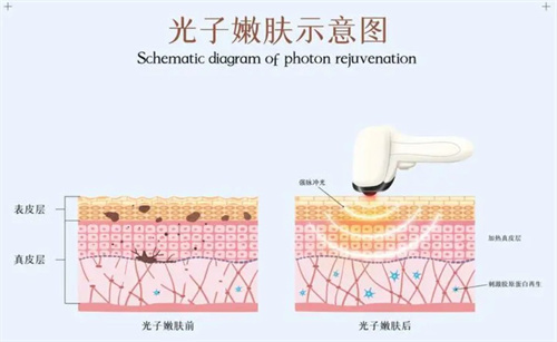 光子嫩肤 光子嫩肤