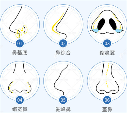 不同隆鼻技术图解 不同隆鼻技术图解
