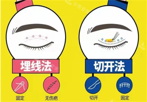 双眼皮埋线和切开对比图 双眼皮埋线和切开对比图