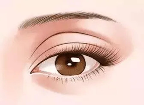 双眼皮修复卡通示意图 双眼皮修复卡通示意图