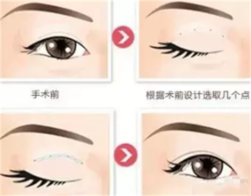 贝塞尔双眼皮手术过程图解 贝塞尔双眼皮手术过程图解