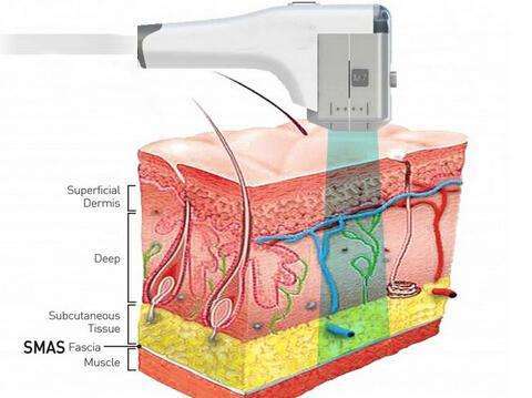日本自由之丘美容整形医院做超声提升价格！单部位9800元起，全脸25410元起，面部+颈部29040元起！